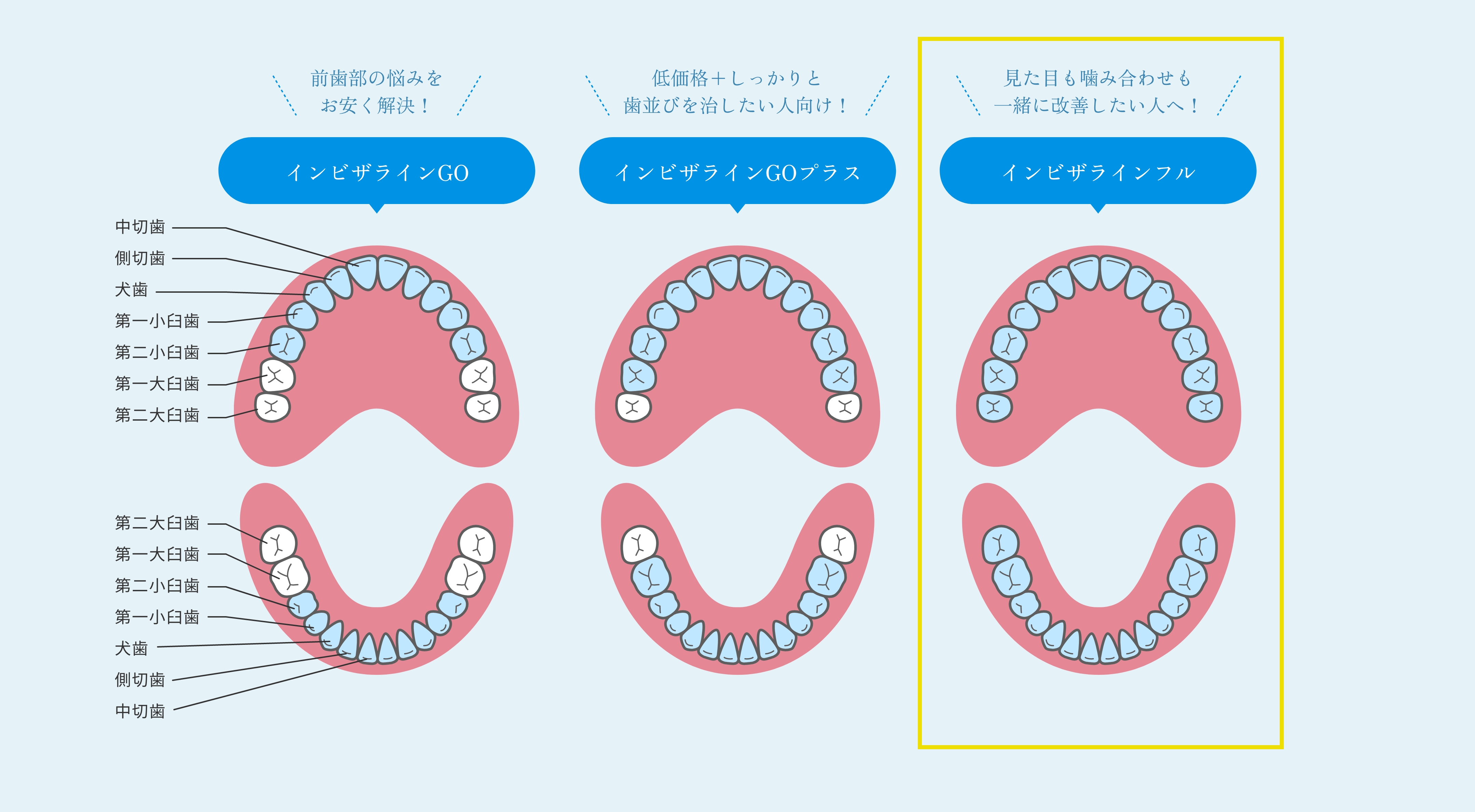 歯並び_インビザラインフル